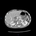 Chance fracture with duodenal and pancreatic lacerations (Radiopaedia 43477-46864 A 4).jpg