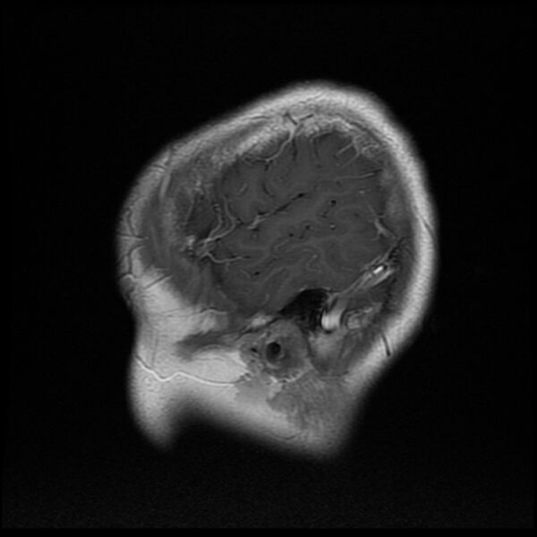 File:Chiasmatic-hypothalamic juvenile pilocytic astrocytoma (Radiopaedia 78533-91236 Sagittal T1 C+ 3).jpg