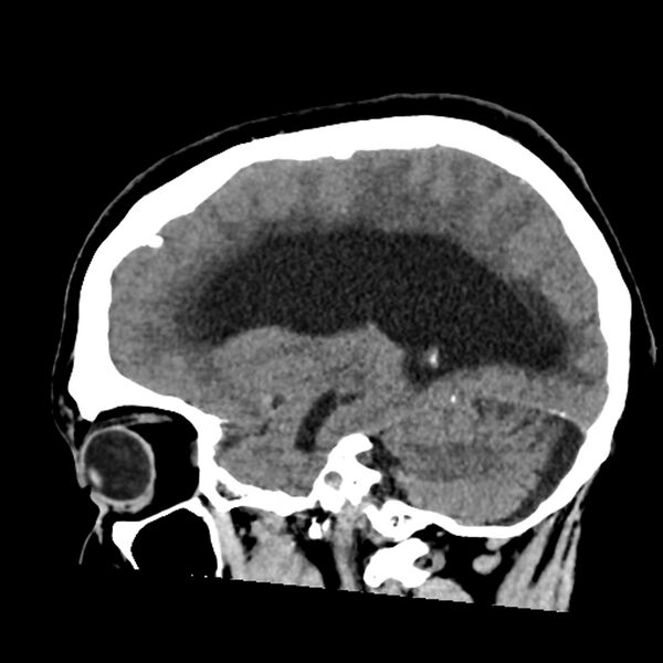 File:Chiasmatic-hypothalamic juvenile pilocytic astrocytoma (Radiopaedia 78533-91237 B 24).jpg