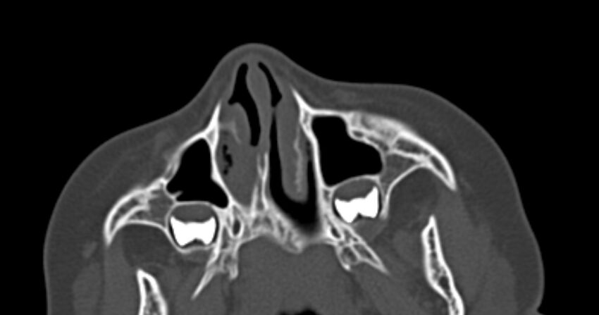 Choanal atresia (Radiopaedia 51295-56972 Axial bone window 14).jpg