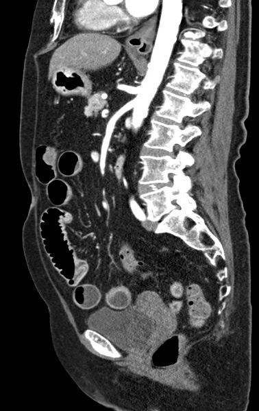 File:Cholecystoduodenal fistula due to calculous cholecystitis with gallstone migration (Radiopaedia 86875-103077 C 29).jpg