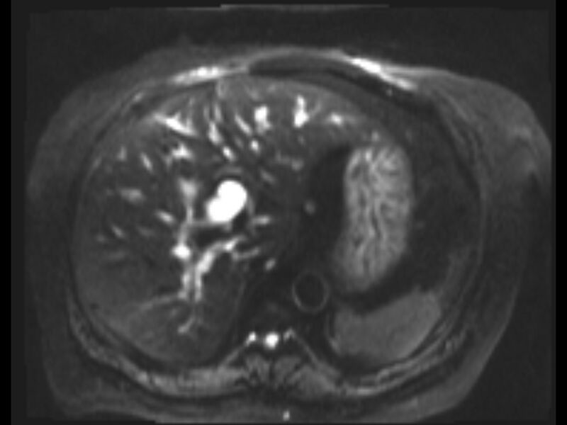 File:Choledocholithiasis causing intrahepatic biliary duct dilation (Radiopaedia 39908-42369 Axial T2 SPAIR 23).jpg