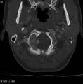 Chondroblastoma - occipital condyle (Radiopaedia 5569-7304 bone window 7).jpg