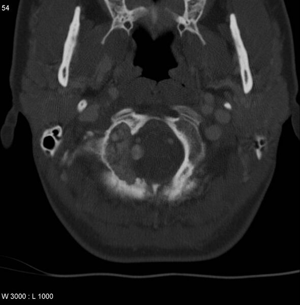 File:Chondroblastoma - occipital condyle (Radiopaedia 5569-7304 bone window 7).jpg