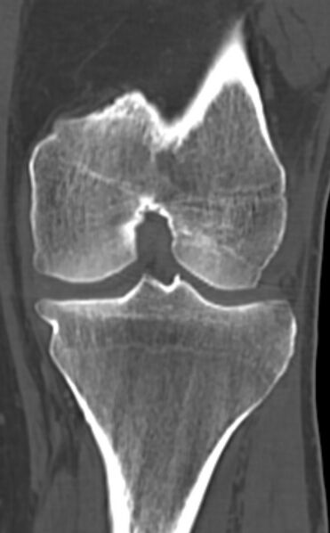 File:Chondrocalcinosis (Radiopaedia 82862-97173 Coronal bone window 47).jpg
