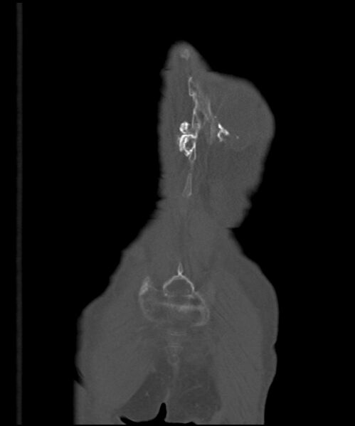 File:Chondrosarcoma of the spine (Radiopaedia 49871-55143 Coronal bone window 2).jpg