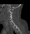 Chordoma (C4 vertebra) (Radiopaedia 47561-52188 Sagittal bone window 30).png