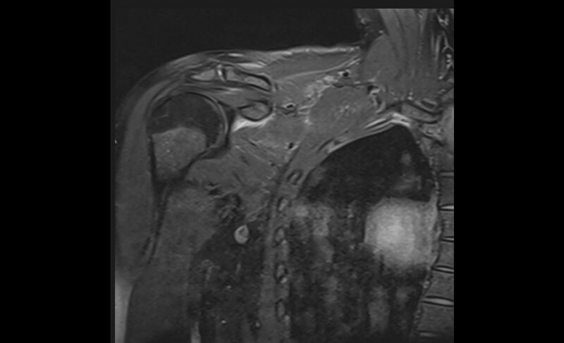 File:Choriocarcinoma in the shoulder (Radiopaedia 28603-28861 Coronal PD FS 8).jpg