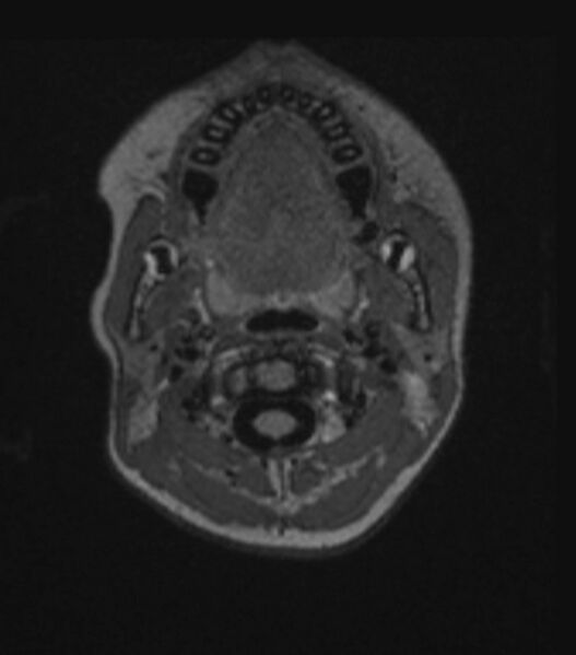 File:Choroid plexus carcinoma (Radiopaedia 91013-108553 Axial FLAIR C+ 49).jpg