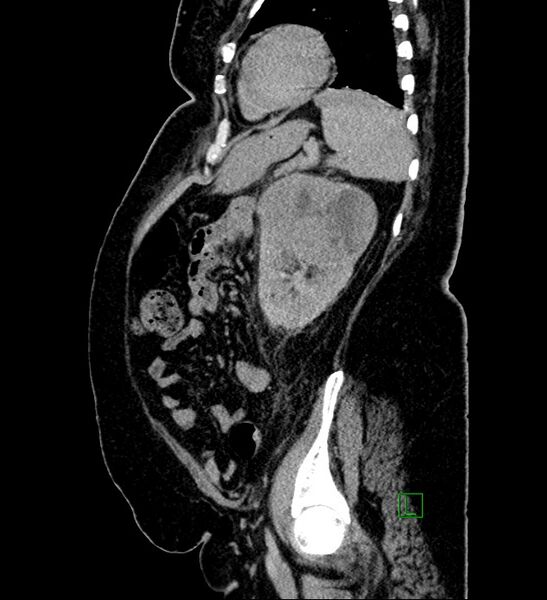 File:Chromophobe renal cell carcinoma (Radiopaedia 84239-99519 G 33).jpg