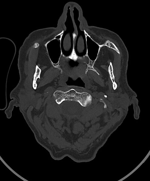 File:Chronic bilateral subdural hygroma (Radiopaedia 85801-101623 Axial bone window 119).jpg