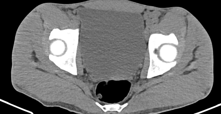 Chronic osteomyelitis (with sequestrum) (Radiopaedia 74813-85822 D 31).jpg