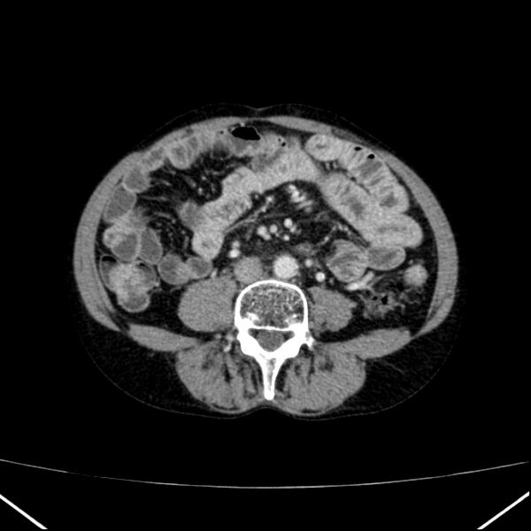File:Chronic pancreatitis (Radiopaedia 23132-23172 B 39).jpg