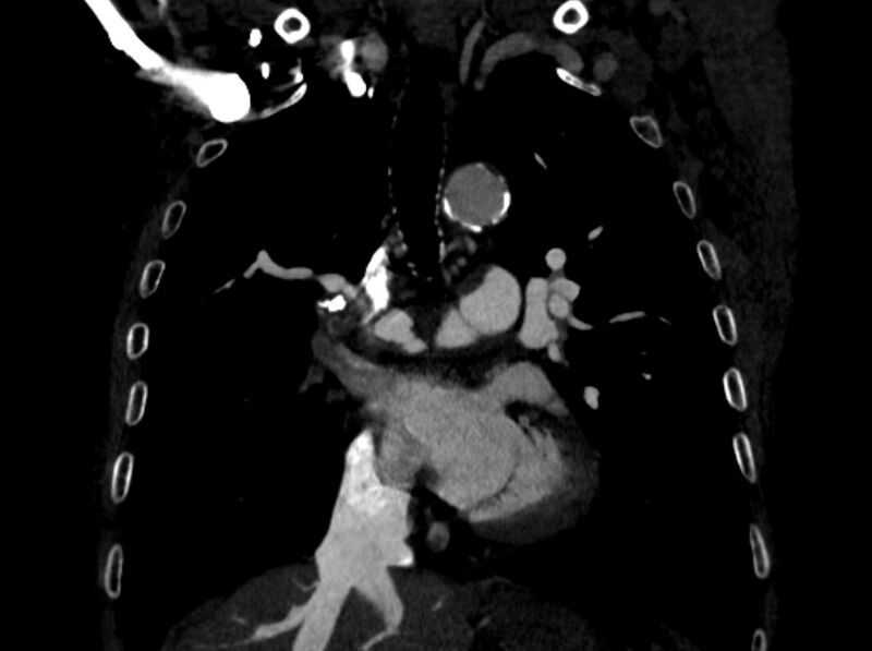 File:Chronic pulmonary embolism (Radiopaedia 91241-108843 A 50).jpg