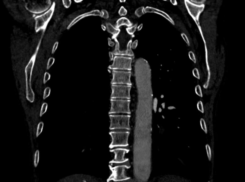 File:Chronic pulmonary embolism (Radiopaedia 91241-108843 A 81).jpg