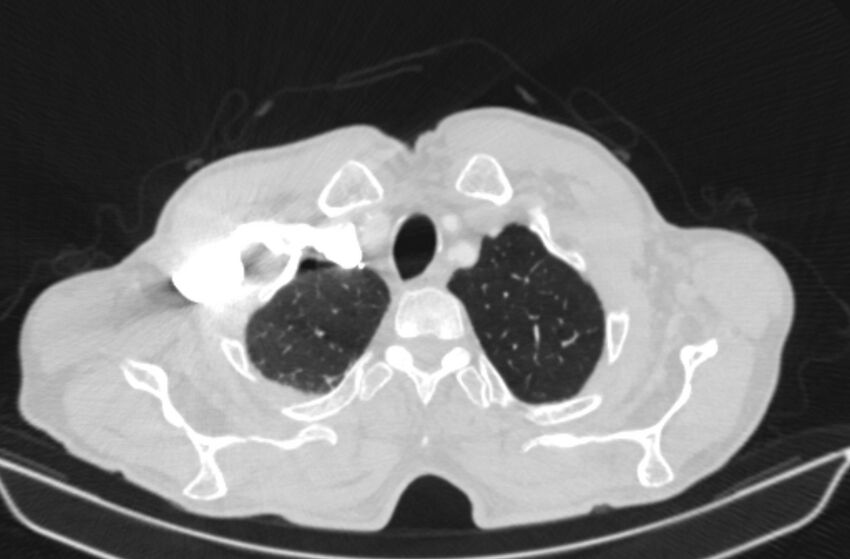 Chronic pulmonary embolism (Radiopaedia 91241-108843 Axial lung window 8).jpg