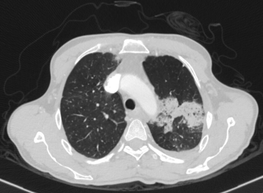 Chronic pulmonary embolism with bubbly consolidation (Radiopaedia 91248-108850 Axial lung window 37).jpg