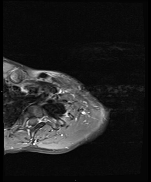 File:Chronic reactive multifocal osteomyelitis (CRMO) - clavicle (Radiopaedia 56406-63114 Axial T1 C+ fat sat 5).jpg