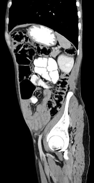 File:Chronic small bowel volvulus (Radiopaedia 75224-86322 C 41).jpg