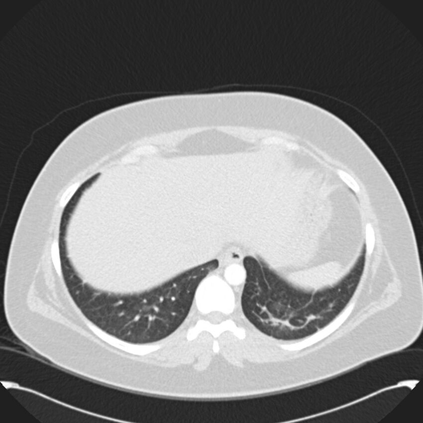 Chronic thromboembolic pulmonary hypertension (CTEPH) (Radiopaedia 74597-85531 Axial lung window 43).jpg