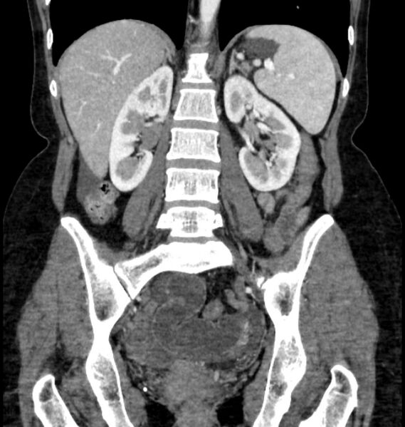 File:Closed loop small bowel obstruction (Radiopaedia 71211-81508 B 81).jpg