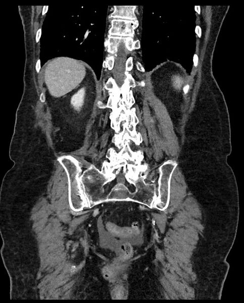 File:Closed loop small bowel obstruction - adhesions (Radiopaedia 59269-66611 B 97).jpg