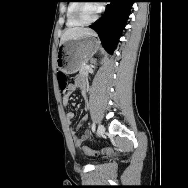 File:Co-existing acute appendicitis and epiploic appendagitis (Radiopaedia 61789-69911 B 58).jpg