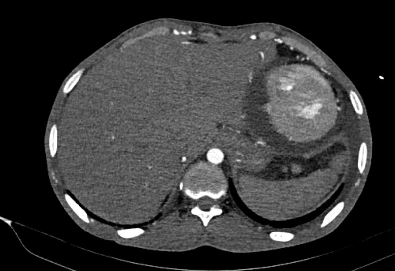 File:Coarctation of aorta with aortic valve stenosis (Radiopaedia 70463-80574 A 213).jpg