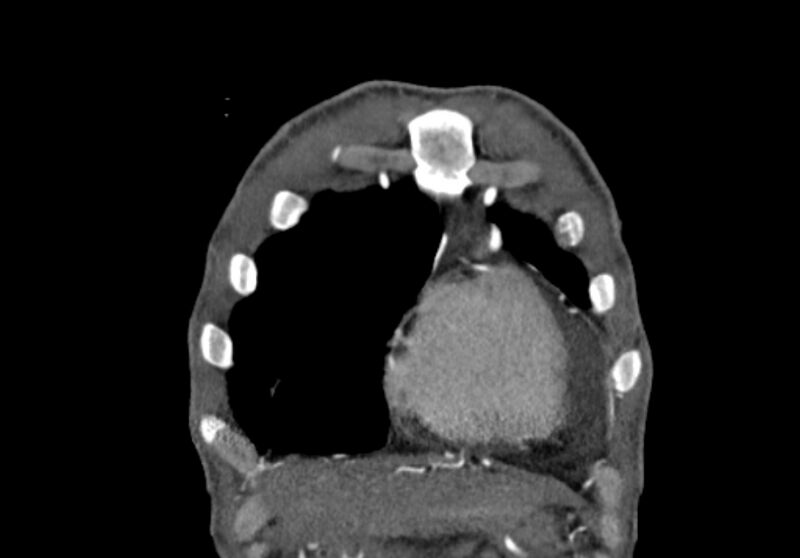 File:Coarctation of aorta with aortic valve stenosis (Radiopaedia 70463-80574 C 9).jpg