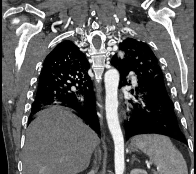 File:Coarctation of the aorta (Radiopaedia 53752-59822 B 55).jpg