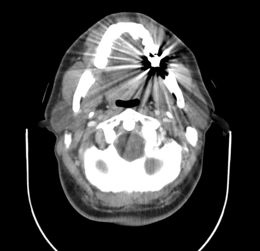 Colloid cyst of thyroid (Radiopaedia 22897-22923 Axial C+ delayed 21).jpg