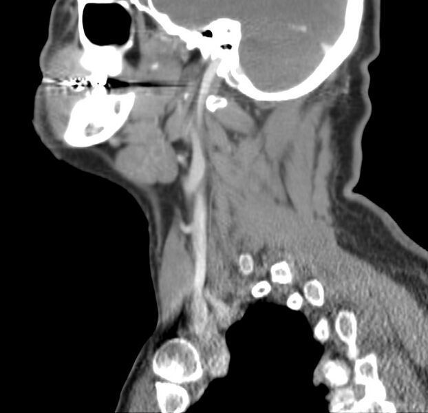 File:Colloid cyst of thyroid (Radiopaedia 22897-22923 Sagittal C+ delayed 20).jpg