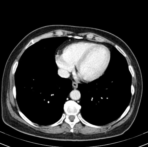 File:Colon carcinoma with hepatic metastases (Radiopaedia 29477-29961 A 4).jpg