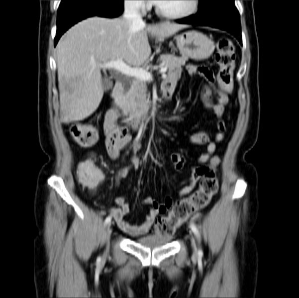 File:Colon carcinoma with hepatic metastases (Radiopaedia 29477-29961 B 18).jpg