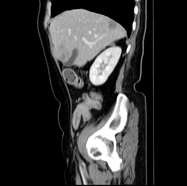 File:Colon carcinoma with hepatic metastases (Radiopaedia 29477-29961 C 15).jpg