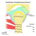 Condylar process fractures (illustration) (Radiopaedia 36206).jpg