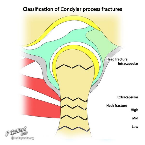 File:Condylar process fractures (illustration) (Radiopaedia 36206).jpg