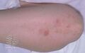 Dermatitis herpetiformis (DermNet NZ immune-dh2).jpg