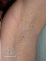 Fox-Fordyce disease (DermNet NZ hair-nails-sweat-fox-fordyce3).jpg