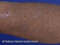 Lichen amyloidosis (DermNet NZ lichen-amyloidosis-23).jpg