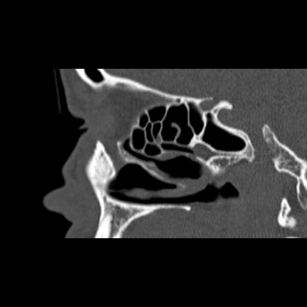 File:Nasal septal perforation (Radiopaedia 25030-25289 Sagittal bone window 45).jpg