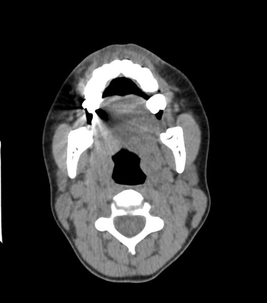 File:Nasoorbitoethmoid fracture (Radiopaedia 90044-107205 Axial non-contrast 81).jpg