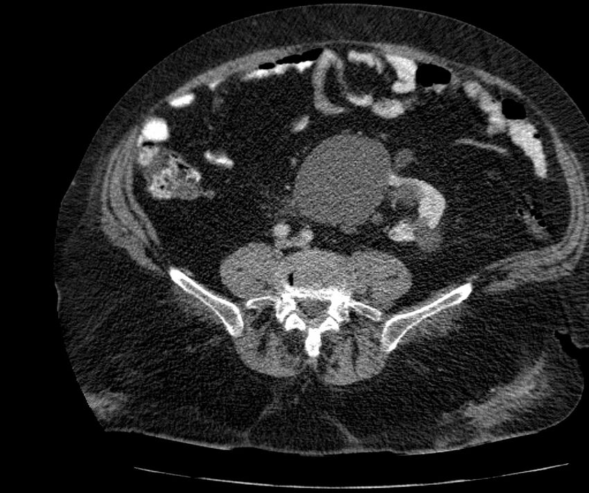 Nephroptosis with inguinal hernia containing perirenal fat (Radiopaedia 56632-63391 C 225).jpg