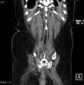 Nerve sheath tumor - malignant - sacrum (Radiopaedia 5219-6987 B 16).jpg