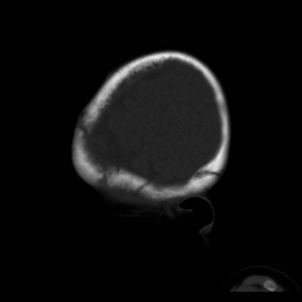 File:Neuroblastoma with skull metastases (Radiopaedia 30326-30958 Sagittal bone window 39).jpg