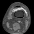 Non-displaced patella fracture (Radiopaedia 15932-15582 Axial PD fat sat 1).jpg