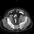 Non Hodgkin lymphoma in a patient with ankylosing spondylitis (Radiopaedia 84323-99621 Axial non-contrast 53).jpg