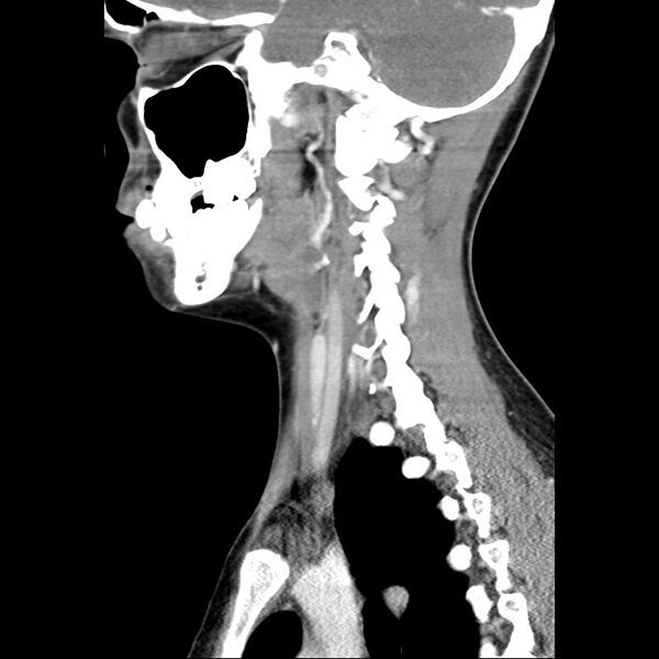 File:Normal CT of the neck (Radiopaedia 14575-14500 Sagittal C+ 34).jpg