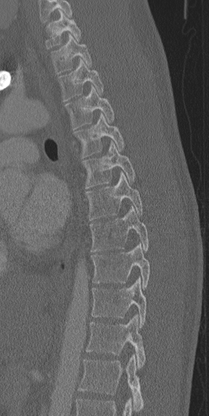 File:Normal CT thoracic spine (Radiopaedia 40181-42688 Sagittal bone window 27).png