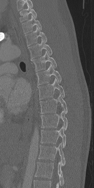 File:Normal CT thoracic spine (Radiopaedia 40181-42688 Sagittal bone window 28).png